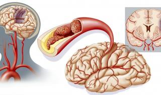 脑梗是什么引起的